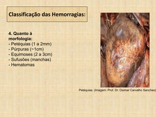 Classificação das Hemorragias:
4. Quanto à
morfologia:
- Petéquias (1 a 2mm)
- Púrpuras (~1cm)
- Equimoses (2 a 3cm)
- Sufusões (manchas)
- Hematomas
Petéquias. (Imagem: Prof. Dr. Osimar Carvalho Sanches)
 