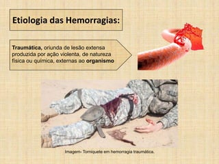 Etiologia das Hemorragias:
Traumática, oriunda de lesão extensa
produzida por ação violenta, de natureza
física ou química, externas ao organismo
Imagem- Torniquete em hemorragia traumática.
 