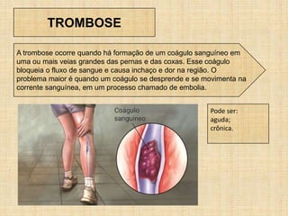 TROMBOSE
A trombose ocorre quando há formação de um coágulo sanguíneo em
uma ou mais veias grandes das pernas e das coxas. Esse coágulo
bloqueia o fluxo de sangue e causa inchaço e dor na região. O
problema maior é quando um coágulo se desprende e se movimenta na
corrente sanguínea, em um processo chamado de embolia.
Pode ser:
aguda;
crônica.
 
