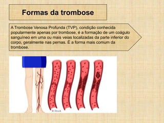 Formas da trombose
A Trombose Venosa Profunda (TVP), condição conhecida
popularmente apenas por trombose, é a formação de um coágulo
sanguíneo em uma ou mais veias localizadas da parte inferior do
corpo, geralmente nas pernas. É a forma mais comum da
trombose.
 