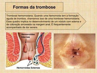 Formas da trombose
Trombose hemorroidaria. Quando uma hemorroida tem a formação
aguda de trombos, chamamos isso de uma trombose hemorroidaria.
Esse quadro implica no desenvolvimento de um nódulo com edema e
de coloração arroxeada na margem anal. É frequentemente
acompanhado de dor severa.
 
