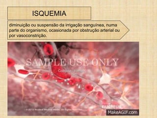 ISQUEMIA
diminuição ou suspensão da irrigação sanguínea, numa
parte do organismo, ocasionada por obstrução arterial ou
por vasoconstrição.
 