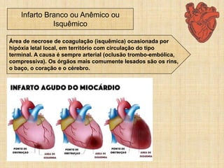 Infarto Branco ou Anêmico ou
Isquêmico
Área de necrose de coagulação (isquêmica) ocasionada por
hipóxia letal local, em território com circulação do tipo
terminal. A causa é sempre arterial (oclusão trombo-embólica,
compressiva). Os órgãos mais comumente lesados são os rins,
o baço, o coração e o cérebro.
 
