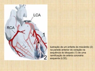 lustração de um enfarte do miocárdio (2)
na parede anterior do coração na
sequência do bloqueio (1) de uma
ramificação da artéria coronária
esquerda (LCE).
 