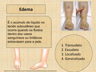 1. Transudato
2. Exsudato
3. Localizado
4. Generalizado
É o acúmulo de líquido no
tecido subcutâneo que
ocorre quando os fluidos
dentro dos vasos
sanguíneos ou linfáticos
extravasam para a pele.
Edema
Disponível em: <https://www.greenme.com.br/viver/saude-e-bem-estar/6940-edemas-tipos-cusas-tratamentos>
 
