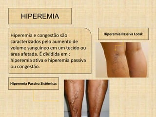 HIPEREMIA
Hiperemia e congestão são
caracterizados pelo aumento de
volume sanguíneo em um tecido ou
área afetada. É dividida em :
hiperemia ativa e hiperemia passiva
ou congestão.
Hiperemia Passiva Local:
Hiperemia Passiva Sistêmica:
 