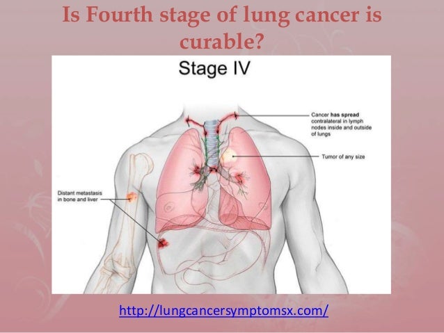 Stage 4 Lung Cancer >> Is Fourth Stage Of Lung Cancer Is Curable Stage 4 Lung Cancer >> Is Fourth Stage Of Lung Cancer Is Curable