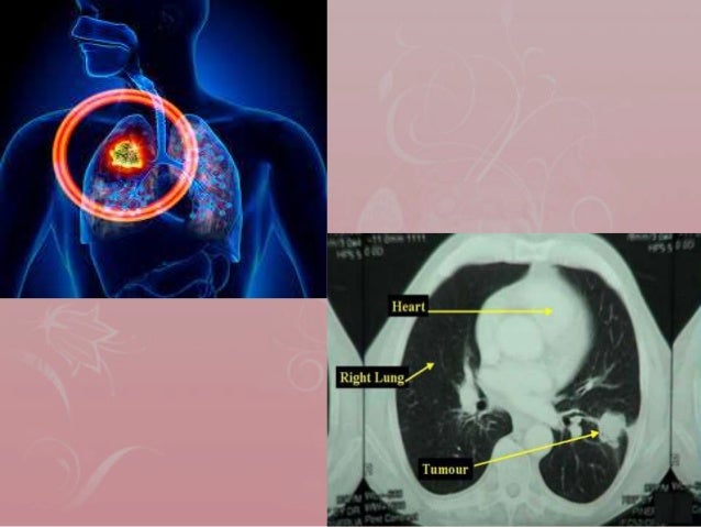 Is fourth stage of lung cancer is curable