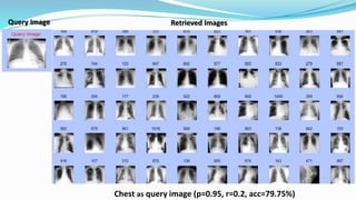 Chest as query image (p=0.95, r=0.2, acc=79.75%)
Query Image Retrieved Images
 