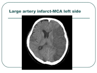Ishcemic and hemorrhagic stroke, a light on integrated approach | PPT ...