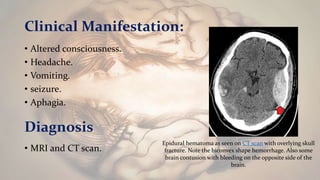 Clinical Manifestation:
• Altered consciousness.
• Headache.
• Vomiting.
• seizure.
• Aphagia.
Diagnosis
• MRI and CT scan.
Epidural hematoma as seen on CT scan with overlying skull
fracture. Note the biconvex shape hemorrhage. Also some
brain contusion with bleeding on the opposite side of the
brain.
 