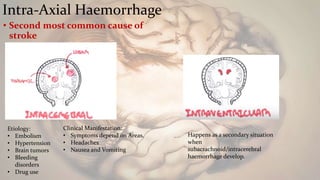 Intra-Axial Haemorrhage
• Second most common cause of
stroke
Etiology:
• Embolism
• Hypertension
• Brain tumors
• Bleeding
disorders
• Drug use
Clinical Manifestation:
• Symptoms depend on Areas.
• Headaches
• Nausea and Vomiting
Happens as a secondary situation
when
subacrachnoid/intracerebral
haemorrhage develop.
 
