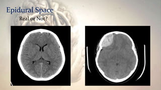 Epidural Space
Real or Not?
 