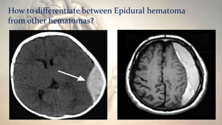 How to differentiate between Epidural hematoma
from other hematomas?
 