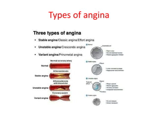 Types of angina
 