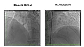 RCA ANGIOGRAM LCA ANGIOGRAM
 