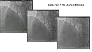 Fielder XT-A for Channel tracking
 