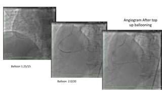Balloon 1.25/15
Balloon 2.0/20
Angiogram After top
up ballooning
 