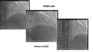 balloon 2.0/20
POBA LAD
 