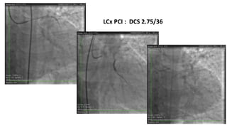 LCx PCI : DCS 2.75/36
 