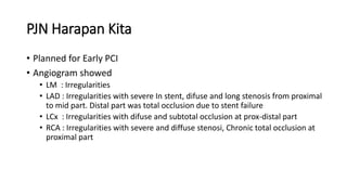 PJN Harapan Kita
• Planned for Early PCI
• Angiogram showed
• LM : Irregularities
• LAD : Irregularities with severe In stent, difuse and long stenosis from proximal
to mid part. Distal part was total occlusion due to stent failure
• LCx : Irregularities with difuse and subtotal occlusion at prox-distal part
• RCA : Irregularities with severe and diffuse stenosi, Chronic total occlusion at
proximal part
 