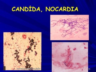 CANDİDA, NOCARDIA 