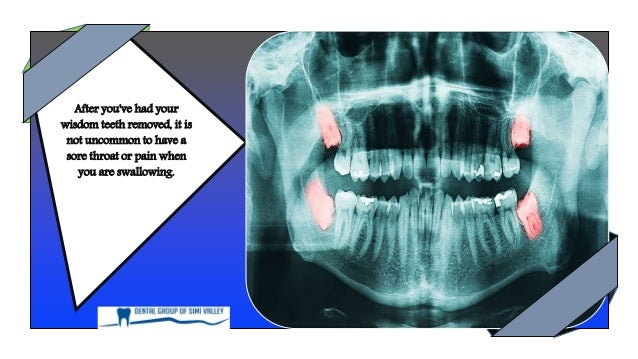 Is It Common To Have Ear Pain After Wisdom Tooth Removal
