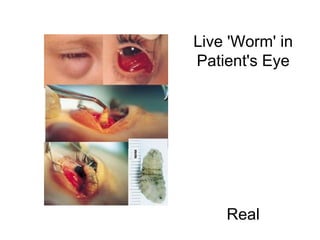 Live 'Worm' in Patient's Eye                                                                                                                                 Real 