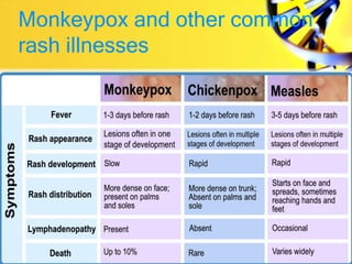 Monkeypox and other common
rash illnesses
 
