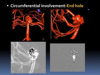 Circumferential involvement-End hole  