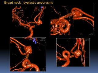 Broad neck , dyplastic aneurysms  