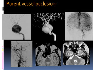 Parent vessel occlusion-Cavernous ICA, dissecting (VA), small peripheral  