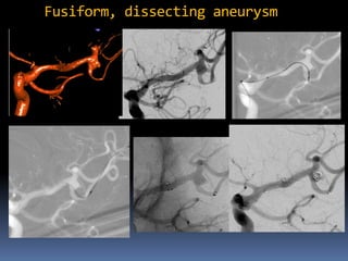 Fusiform, dissecting aneurysm  