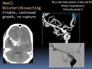 38 yr old male patient, 2-day old SAH 
Known hypertensive 
Clinically grade II 
Small Blister/dissecting Friable, continued growth, re-rupture  