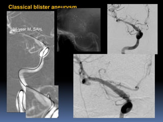 Classical blister aneurysm 
34-year M, SAH  
