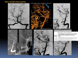 Very small aneurysms  