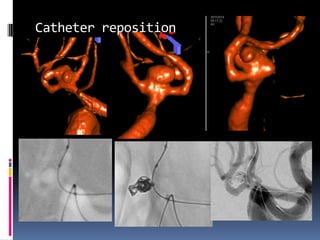 Catheter reposition  