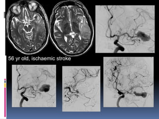 56 yr old, ischaemic stroke  