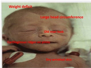 Weight deficit
Dry wrinkled skin
Large head circumference
Old man look
Cartilaginous ridges on pinna
 