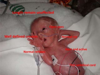 Length remain unaffected
Open eyes
Thin umbilical cord
Well defined creases
Normal reflexes
Alert and active
Normal cry
 