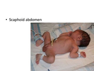 • Scaphoid abdomen
 