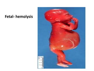 Fetal- hemolysis
 