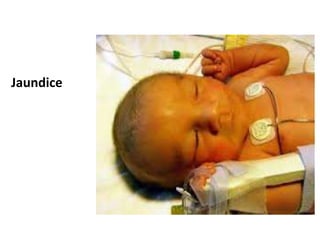 Jaundice
 