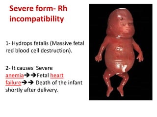 Severe form- Rh
incompatibility
1- Hydrops fetalis (Massive fetal
red blood cell destruction).
2- It causes Severe
anemiaFetal heart
failure Death of the infant
shortly after delivery.
 