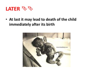 LATER 
• At last it may lead to death of the child
immediately after its birth
 