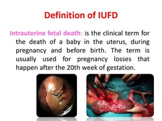 Definition of IUFD
Intrauterine fetal death: is the clinical term for
the death of a baby in the uterus, during
pregnancy and before birth. The term is
usually used for pregnancy losses that
happen after the 20th week of gestation.
 