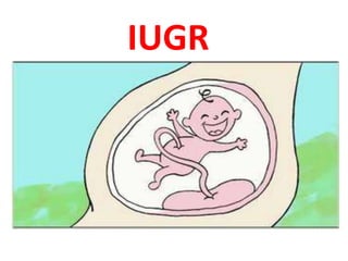 IUGR
 