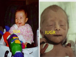 SGA IUGR
 