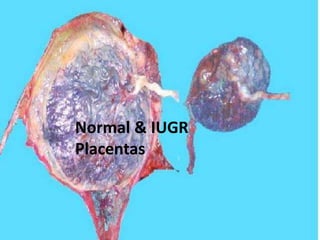 Normal & IUGR
Placentas
 