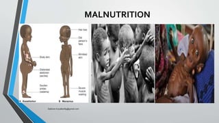 MALNUTRITION
Saikiran.Koyalkar89@gmail.com
 